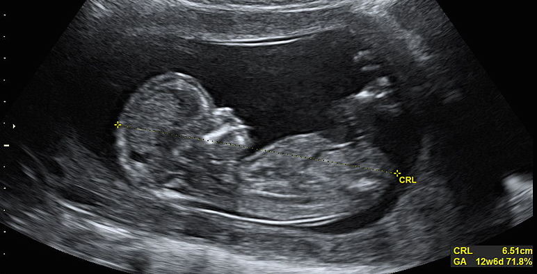ultrasound abortion Planned Parenthood